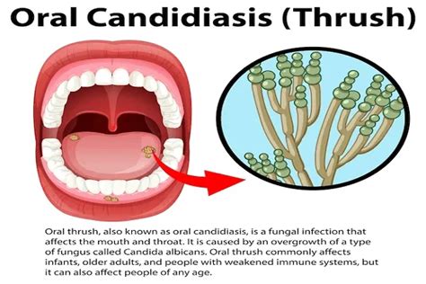 Candidiasis oral: causas, sintomas y tratamiento -P&P Clinic