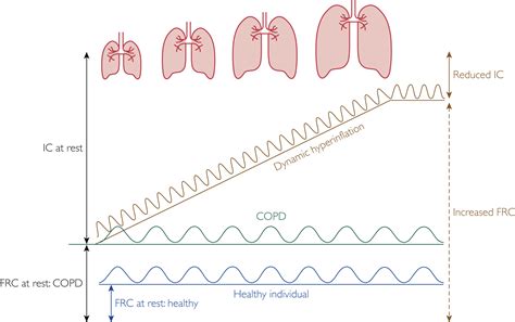 Why We Should Target Small Airways Disease in Our Management of Chronic Obstructive Pulmonary ...