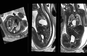 Image result for Fetalscreen II