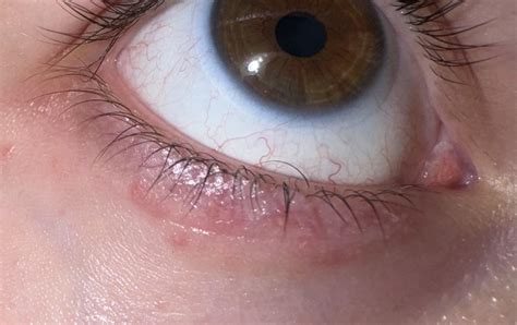 Advice on how to get rid of under eye redness/irritation : r/SkincareAddicts