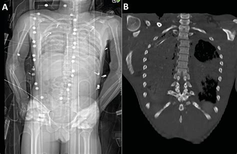 Das digitale Ganzkörper-Röntgen - Orthopädie & Traumatologie ...
