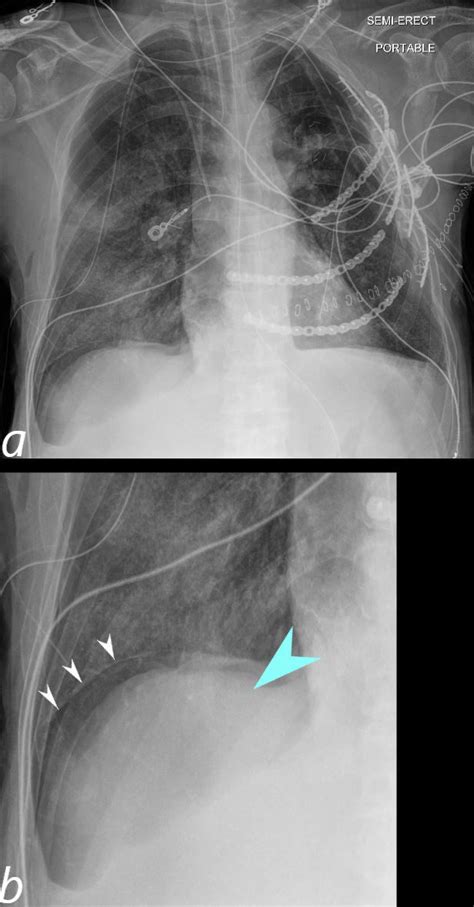 Sulcus Sign Explained 的图像结果