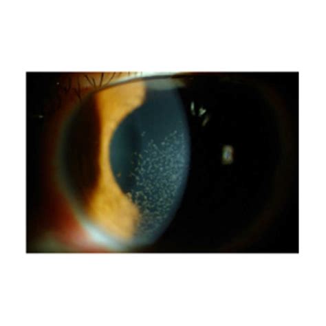 Image result for Slit Lamp Microscope View