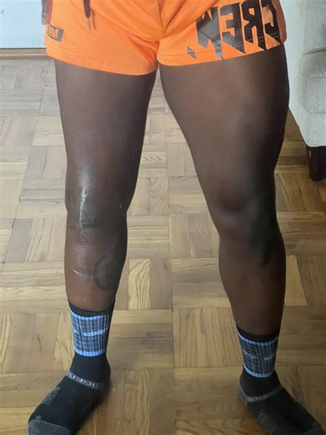 Torn / ruptured patellar tendon . Long road to getting size back : r/moreplatesmoredates