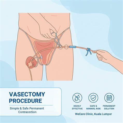 Does A Vasectomy Affect Male Hormones? | WeCare Clinic
