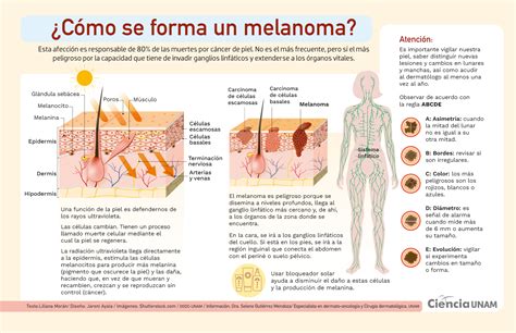 Cáncer de piel: el melanoma - Ciencia UNAM