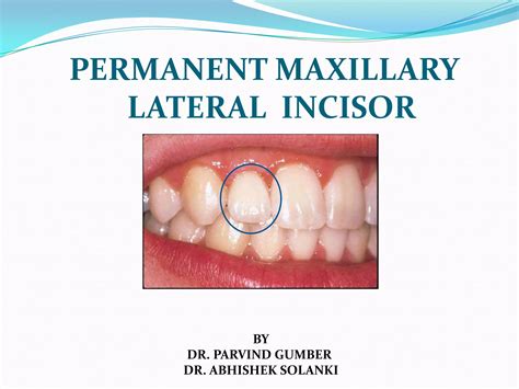 Permanant Maxillary Lateral Incisor | PPTX