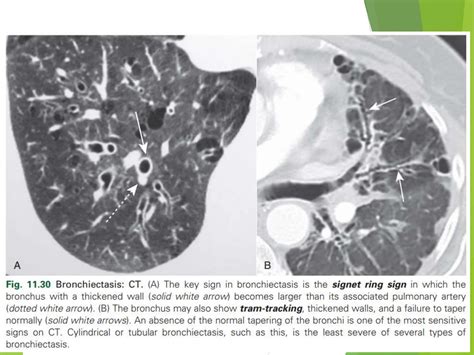 Diagnosis and Imaging of Bronchiectasis.ppt
