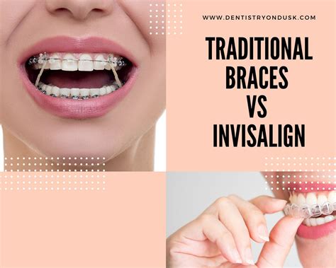 Invisalign Vs Braces