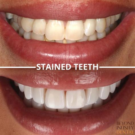 How To Do Veneers At Home at James Goldsbrough blog