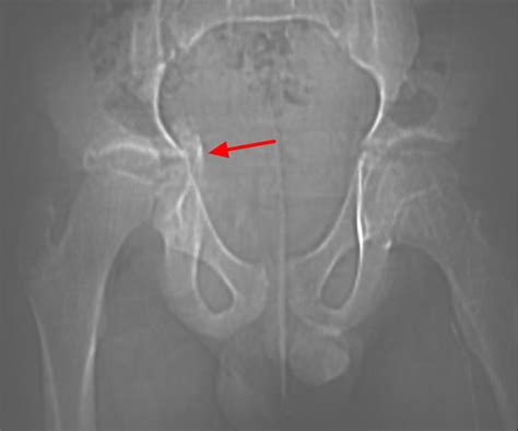 Growth Plate Fracture - Causes, Types, Symptoms,Treatment