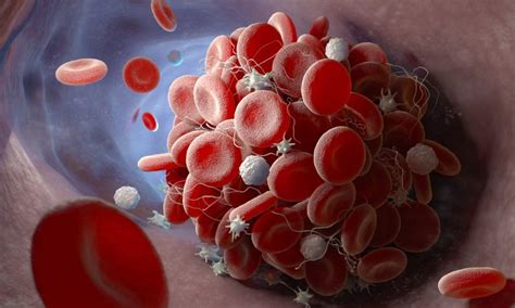 Thromboprophylaxis with aspirin non-inferior to heparin after fracture ...