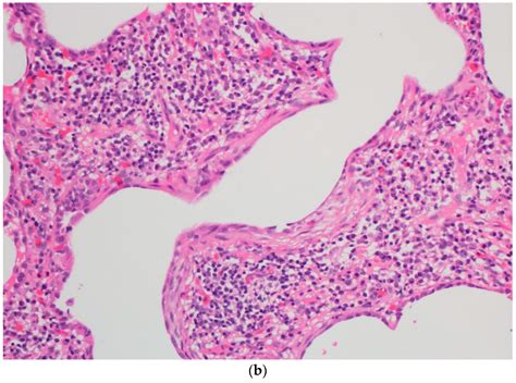 A Rare Pediatric Case of Severe Bird Fancier’s Lung Presented with ...