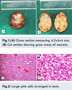 Non-cardiogenic Pulmonary Edema as the First Manifestation of Extra ...