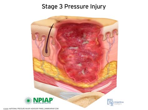 Stage 1 Pressure Ulcer