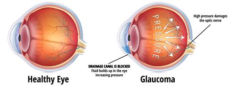 Glaucoma – EyeCare Associates of South Tulsa