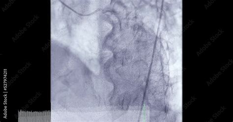 Coronary Angiogram Procedure 的图像结果