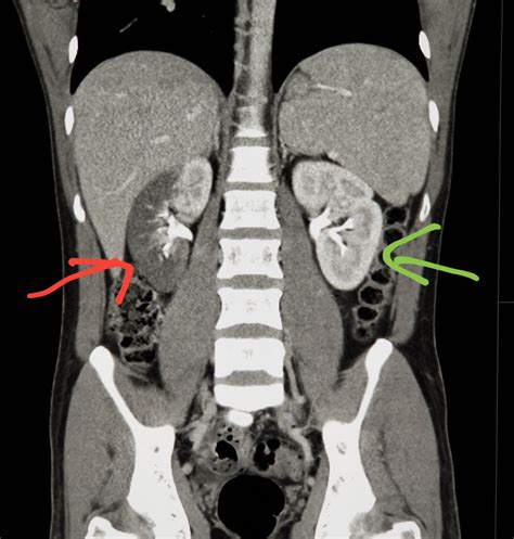 #Abdomen #CT shows #blood flow blocked to the #kidney (red: #renal #infarct). Green is normal. # ...