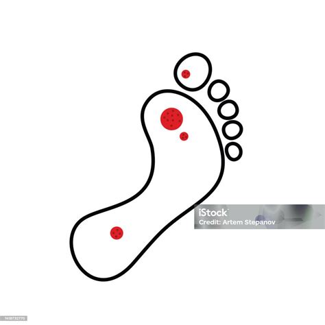 Plantar Wart Icon Stock Illustration - Download Image Now - Wart, Alternative Therapy, Anatomy ...