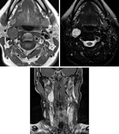 Glomus Tumor Mri