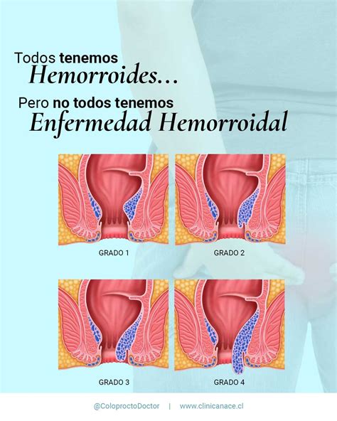 Anatomía De Las Hemorroides