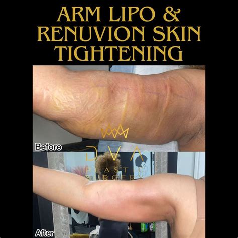 Arm Lipo & Renuvion Skin Tightening - DVA Plastic Surgery