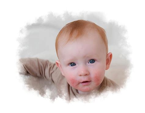 Atopic Dermatitis Treatment in Ayurveda