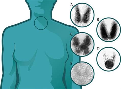 Thyroid disorders or dysfunctions — lesson. Science State Board, Class 10.