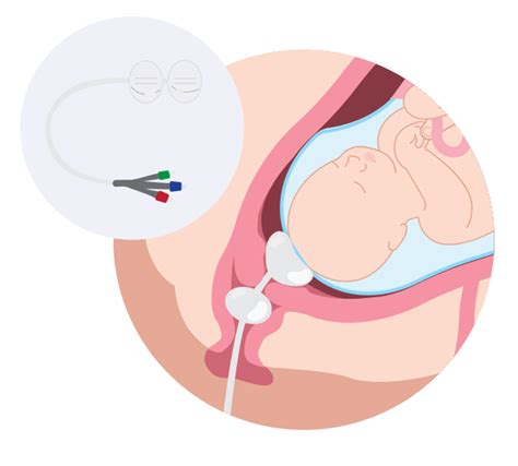 Induction Of Labour With Balloon