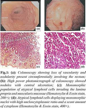Primary Mantle Cell Lymphoma of Rectum with Rare Presentation: A Unique ...
