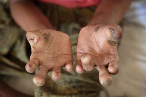 What is Leprosy - Amoghavarsha IAS Academy