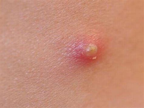 Image result for boils cysts abscesses exploding