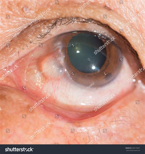 Cyst In Eye