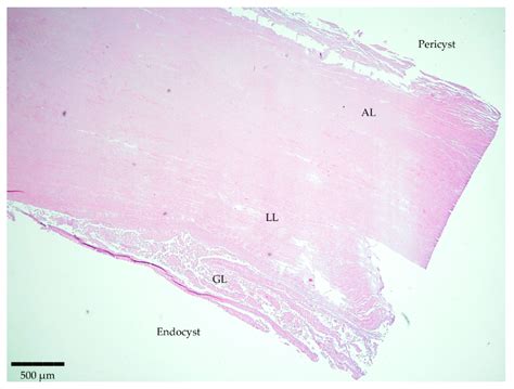 Immunohistochemistry as a Reliable Tool for the Diagnosis of Cystic ...