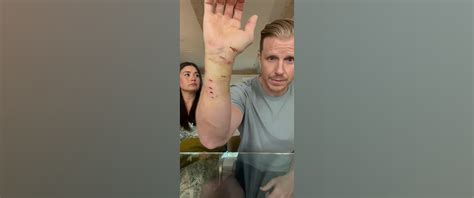 'Bachelor' alum Sean Lowe details injuries after attack by rescue dog ...