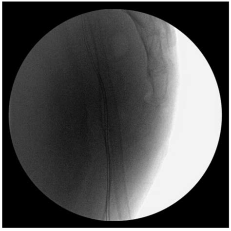 Minimally Invasive Open Reduction and Maintenance Technique for ...