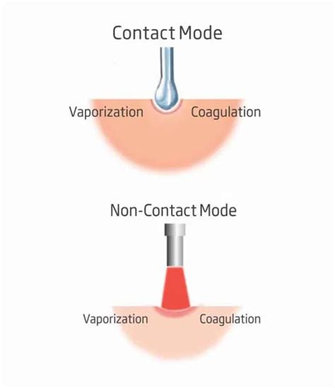 Lasotronix is the industry leader | Lasotronix Smart M The best and the ...