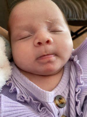 Alergias o bolitas en mi bebe | BabyCenter