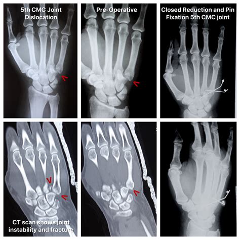 Image result for Finger Dislocation Reduction