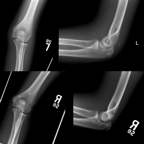 Pediatric Elbow Fracture | Pediatric Radiology Reference Article | Pediatric Imaging | @pedsimaging