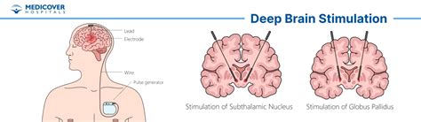 Deep Brain Stimulation: Preparation, Procedure and Recovery