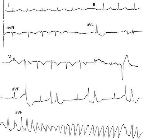 例18.尖端扭转型室性心动过速(图3-31)-心血管-医学