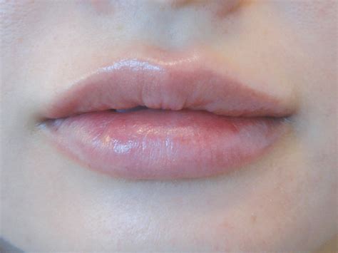 Case Study - Lip filler allergic reaction - After - Aesthetic Medical Practitioner