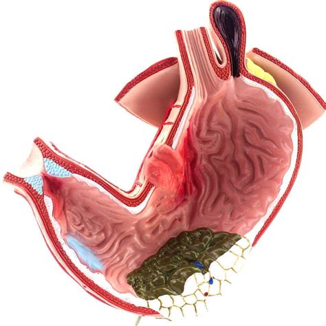 Buy Magenanatomiemodel, medical anatomical model 1: 1 Human tric lesion ...
