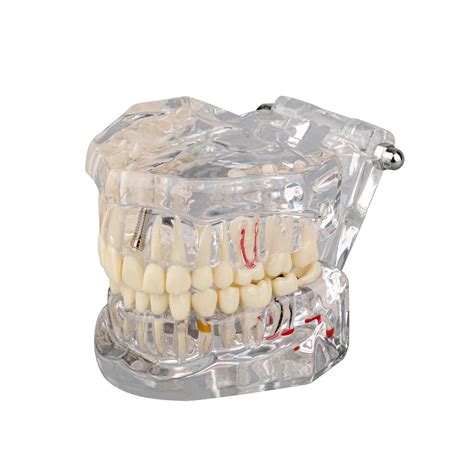 Transparent Disease Teeth Model With Dental Implant Bridge Dental Model ...