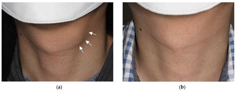 Thyroglossal Duct Cyst Scar