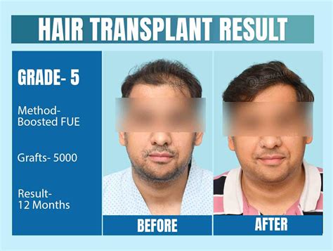 Hair Transplant Clinic in Delhi, India | Best Hair Transplant in Delhi