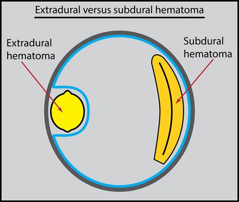 Extradural Vs Subdural Haematoma