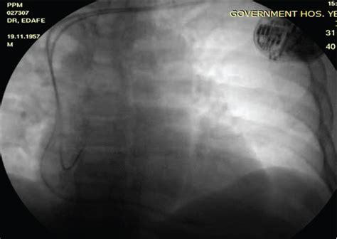 Right Hemi-Diaphragmatic Twitching: A Case of Atrial Lead Displacement ...