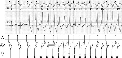 “Wide-narrow-wide” QRS complex tachycardia: What is the mechanism? - Heart Rhythm